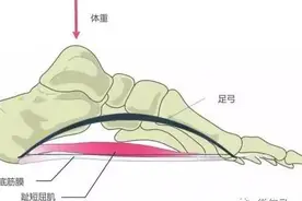 脚底板子疼，可能是得了足底筋膜炎，遇到这个病怎么办？请看此文图片