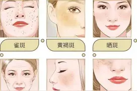 你的色斑属于什么类型的图片