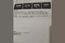 甲状腺全切后有了很多后遗症，我自己亲身经历图片