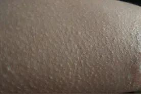 “鸡皮肤”世界上近一半人都有，医生提醒这4点患者要注意图片