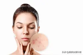 痘痘（痤疮）、粉刺要避开的地雷食物？这两大类要注意图片