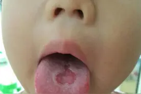 孩子的“地图舌”是因为这，了解清楚后，拯救孩子的“地图舌”图片