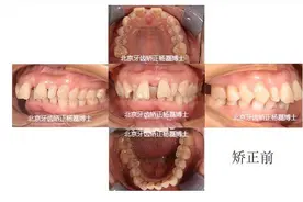 杨磊博士正畸｜重度牙周炎牙齿松动高龄隐适美矫正图片