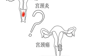 谈谈宫颈那些事图片