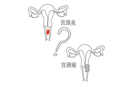 谈谈宫颈那些事图片