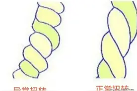 健康科普堂 | 说说脐带扭转图片