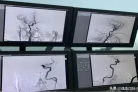 健康科普堂 | 您了解脑血管造影检查是什么感觉吗？图片