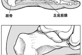 脚底长骨刺穿什么鞋图片