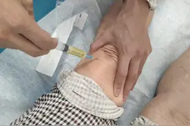 左膝盖一针搞定，阿姨反复痛了25年，这个月加重明显图片