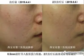 【微针】“滚”出来的无暇素颜美肌图片