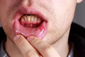 长期口腔溃疡，是因为缺维生素？错误的“常识”太误导人了图片