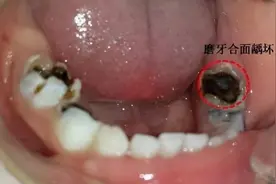 5种牙齿问题，大部分孩子逃不掉！尤其是最后一个，避开就是省钱图片