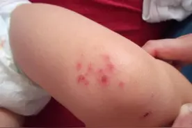 胖宝宝起红疹，清洁干爽最重要图片
