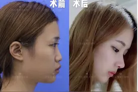鼻基底填充到底用哪种材料，才不影响表情？图片
