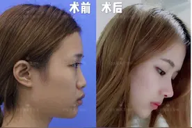鼻基底填充到底用哪种材料，才不影响表情？图片