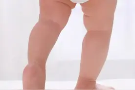 【可能致残】​腿纹、臀纹不对称，谨防发育性髋关节脱位！【呱呱教·128】图片
