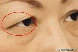 上眼皮松弛，要做手术"去皮、提上去"?  听听医生怎么说图片