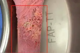 把骨头煮熟、冷冻后再放回去：这种方法治疗骨癌，靠谱吗？图片