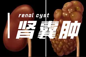 肾囊肿的了解和防治图片