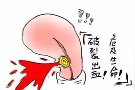 剖腹产瘢痕部位妊娠——妊娠之“坑”图片