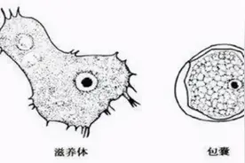 戴隐形眼镜后险丧命！医生忠告：隐形与美瞳很多人都用错了图片