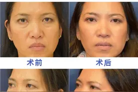 做过“祛眼袋手术”的人，同你讲几句真心话图片