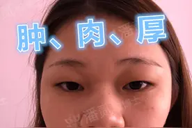 什么类型的肿眼泡/肿泡眼，别指望变薄眼皮？—眼整形双眼皮手术图片