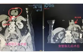 83岁老人胃“移位”突发呕血 原来是患上了这个病图片