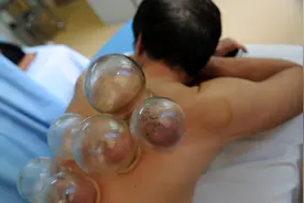 拔火罐时，后背吸出来的瘀血，真的是毒素吗？听听医生怎么说的图片
