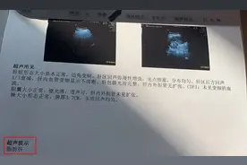 女子连续20天夜夜将小龙虾当夜宵，导致「孕妇杀手」找上门...图片