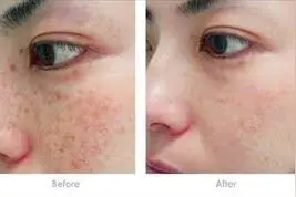 减轻面部色素沉着的10种小妙招图片