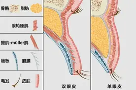 双眼皮怎么区分是肉条还是没消肿？图片