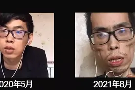 肠癌晚期！34岁博主一年后变“老人”，80%直肠癌曾被误以为是痔疮图片