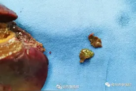 浙江杭州27岁女子生吃荸荠体内取出2条虫，医生提醒：姜片虫感染有潜伏期图片