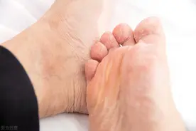 脚莫名瘙痒、脱皮？可能得了脚气，做好这3点很关键图片
