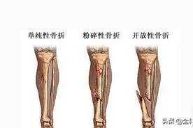 「健康教育处方」外科常见疾病——四肢骨折图片