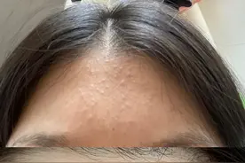 如何去脸上的闭口？个人成功经历分享图片