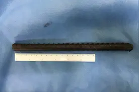 一米长钢筋穿透手臂，简阳医生成功为伤者取出图片