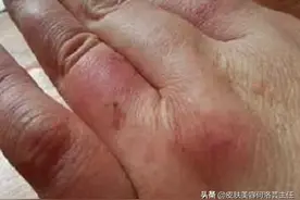 冬天冻疮又疼又痒，不能用火烤？不能用热水泡？别再搞错了图片
