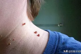 与你说说颈部小肉球的那些事，抠掉会怎样？如何处理？一文看懂图片