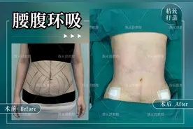 苹果型身材你知道多少？腰腹吸脂更容易改善苹果型身材哦图片
