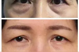 "切眉+去眼袋"后的她重返青春！但这些你需要注意图片