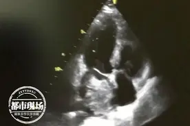 男子小腿渐渐发紫，到医院一查，发现心脏出了大问题图片
