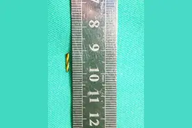 拔智齿时金属车针断裂，男子上颈部残留断针，西安医生用“导航技术”成功取出图片