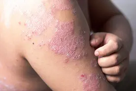 银屑病（牛皮癣），能够治愈吗？中医给出5种用药方案，看看无妨图片
