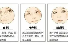 为啥脸上的斑那么顽固难以去除图片