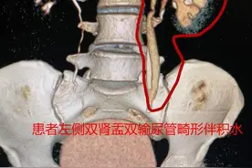男子天生三个肾 却被小结石撂倒图片