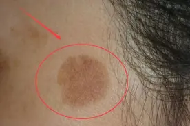 皮肤突然冒出“老年斑”, 药店角落1乳膏, 每晚搽一搽图片