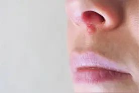 鼻咽癌和鼻炎的区别？医生：重视鼻塞、流涕症状，早日揪出癌细胞图片
