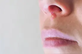 鼻咽癌和鼻炎的区别？医生：重视鼻塞、流涕症状，早日揪出癌细胞图片